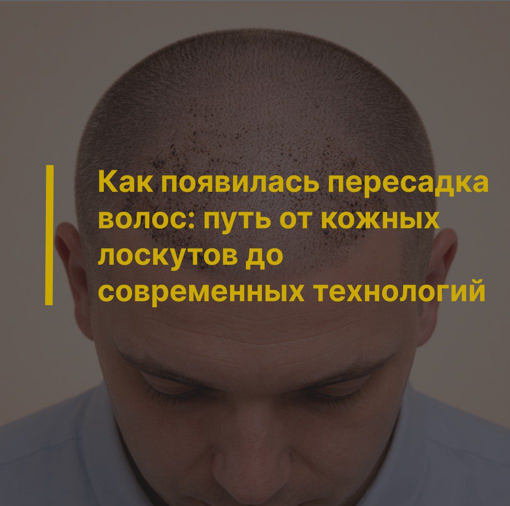 Как появилась пересадка волос: путь от кожных лоскутов до современных технологий