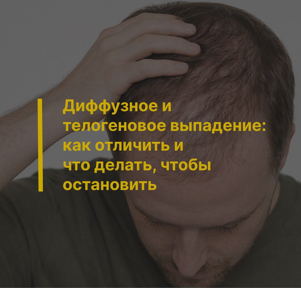 Диффузное и телогеновое выпадение: как отличить и что делать, чтобы остановить