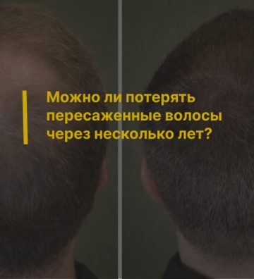 Можно ли потерять пересаженные волосы через несколько лет?