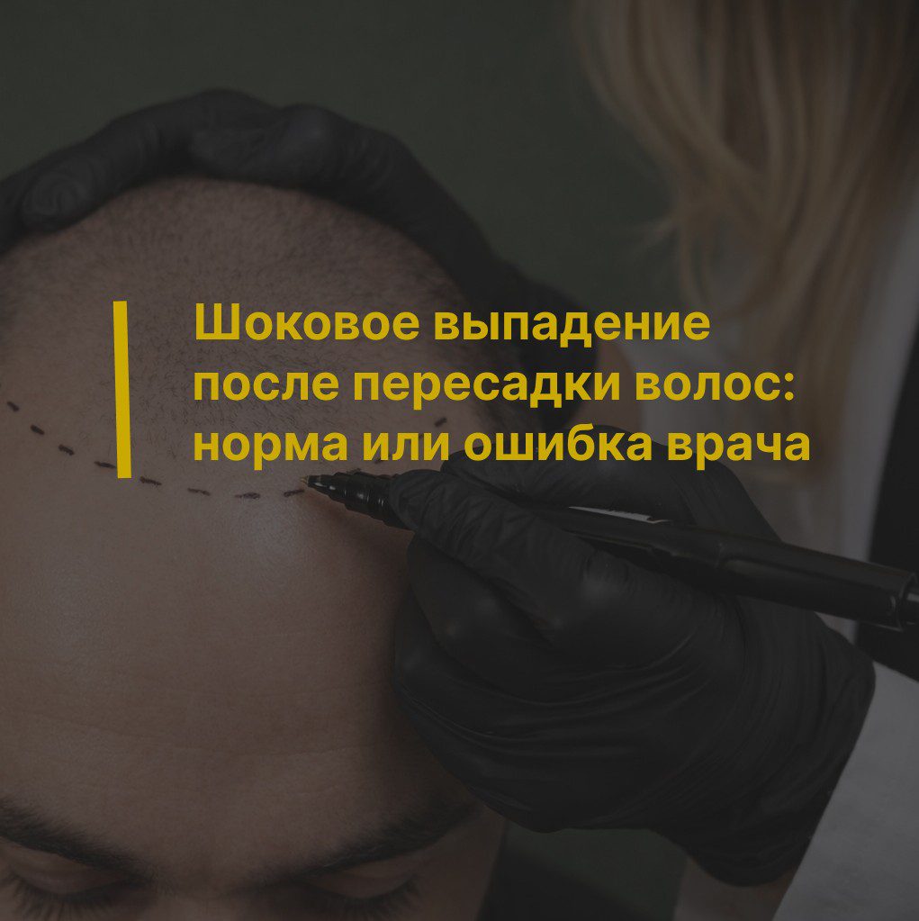 Шоковое выпадение после пересадки волос: норма или ошибка врача