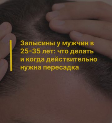Залысины у мужчин в 25–35 лет: что делать и когда действительно нужна пересадка