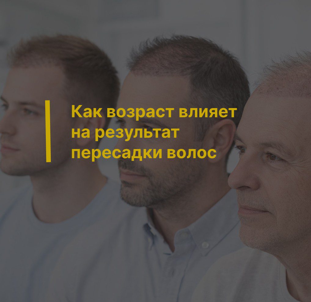 Как возраст влияет на результат пересадки волос